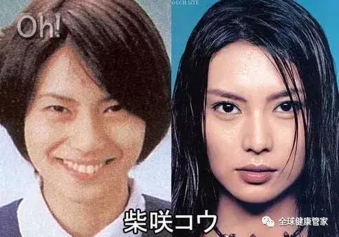 日本最新嘴角 整容,最新嘴角整形技术解析